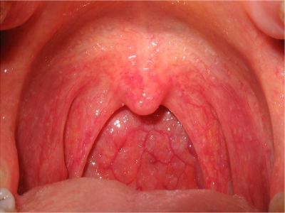 Viêm họng là gì, nguyên nhân và cách điều trị